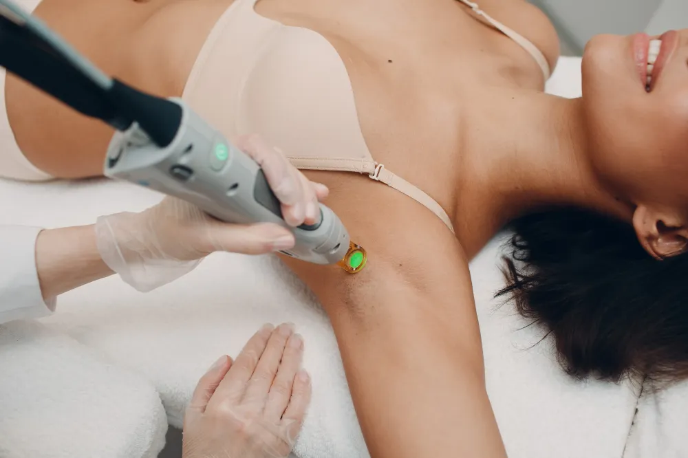 Dépilation laser